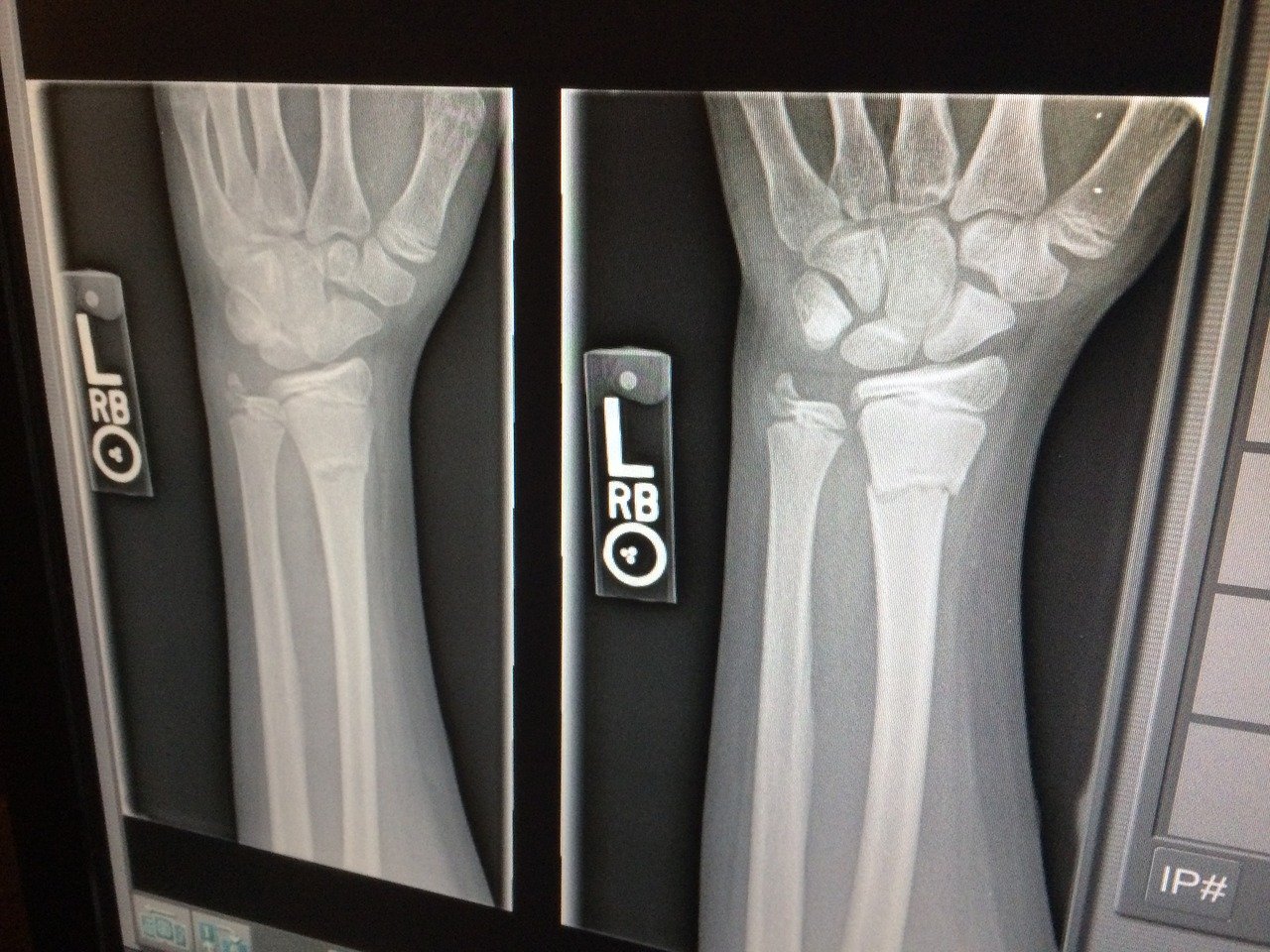 xray