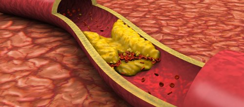 Blutgefäß, Fettgewebezelle, Blut, Menschliche Arterie, Cholesterin