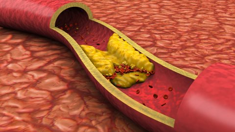 Blutgefäß, Fettgewebezelle, Blut, Menschliche Arterie, Cholesterin